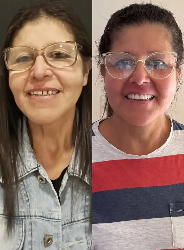 Rose Cler — antes e depois na Zafinne Odontologia